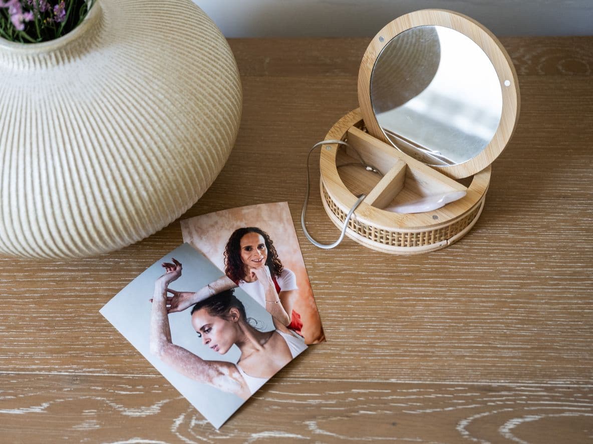 Two printed photos displayed on a table showing Natalie proudly displaying her vitiligo